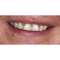 2. Zahnfleischepithese